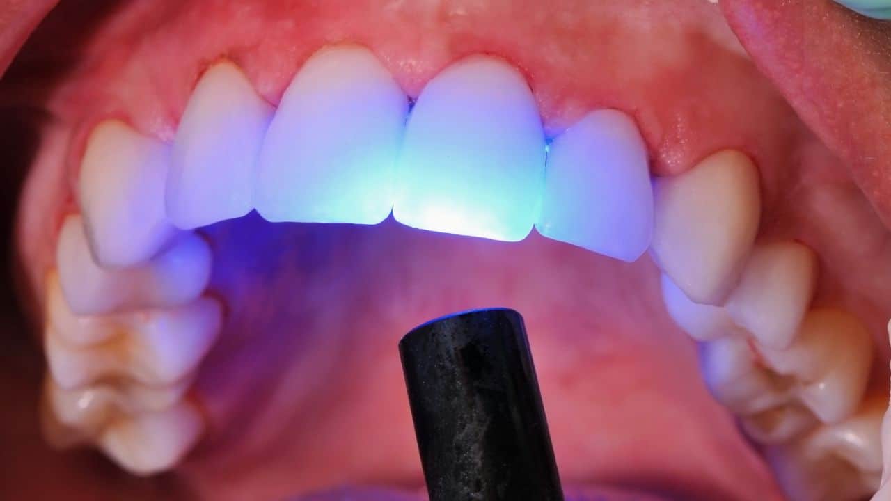 smile-solutions-dental-practise-laser-treatments