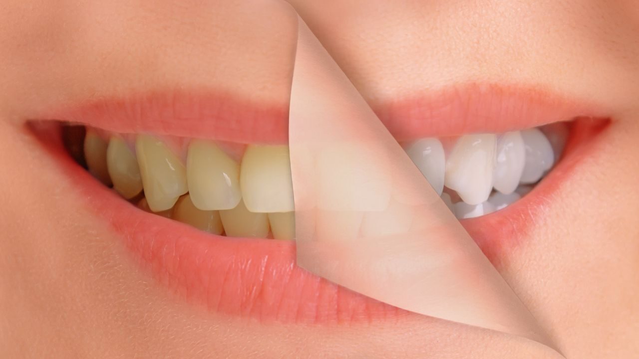 smile-solutions-dental-practise-teeth-whitening
