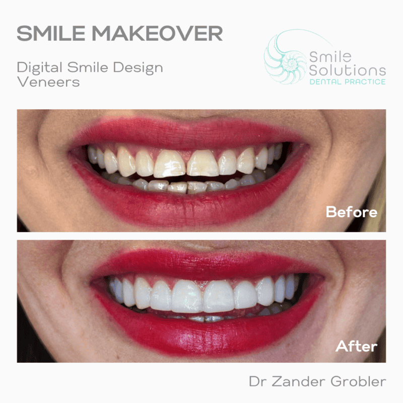 Smilesolutions-dentist-pretoria-smile-makeover