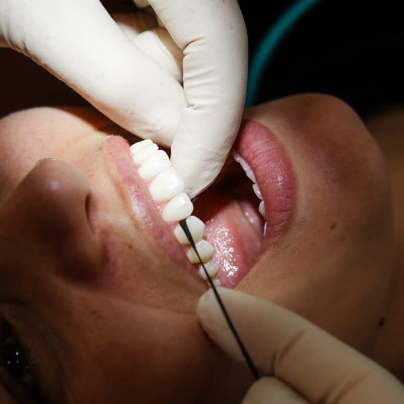 smile-solutions-dental-pretoria-teeth-cleaning-01
